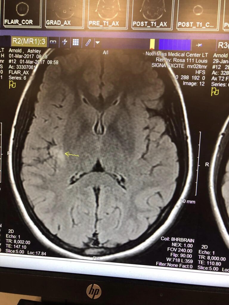 Scan of Ashley's Brain Tumor